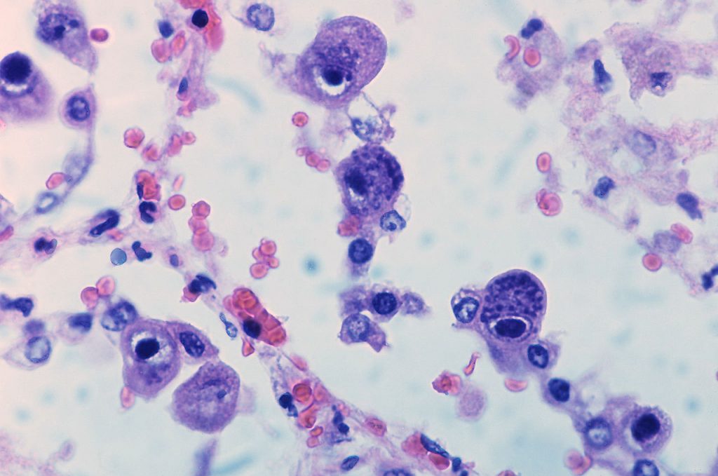 trasmissione citomegalovirus