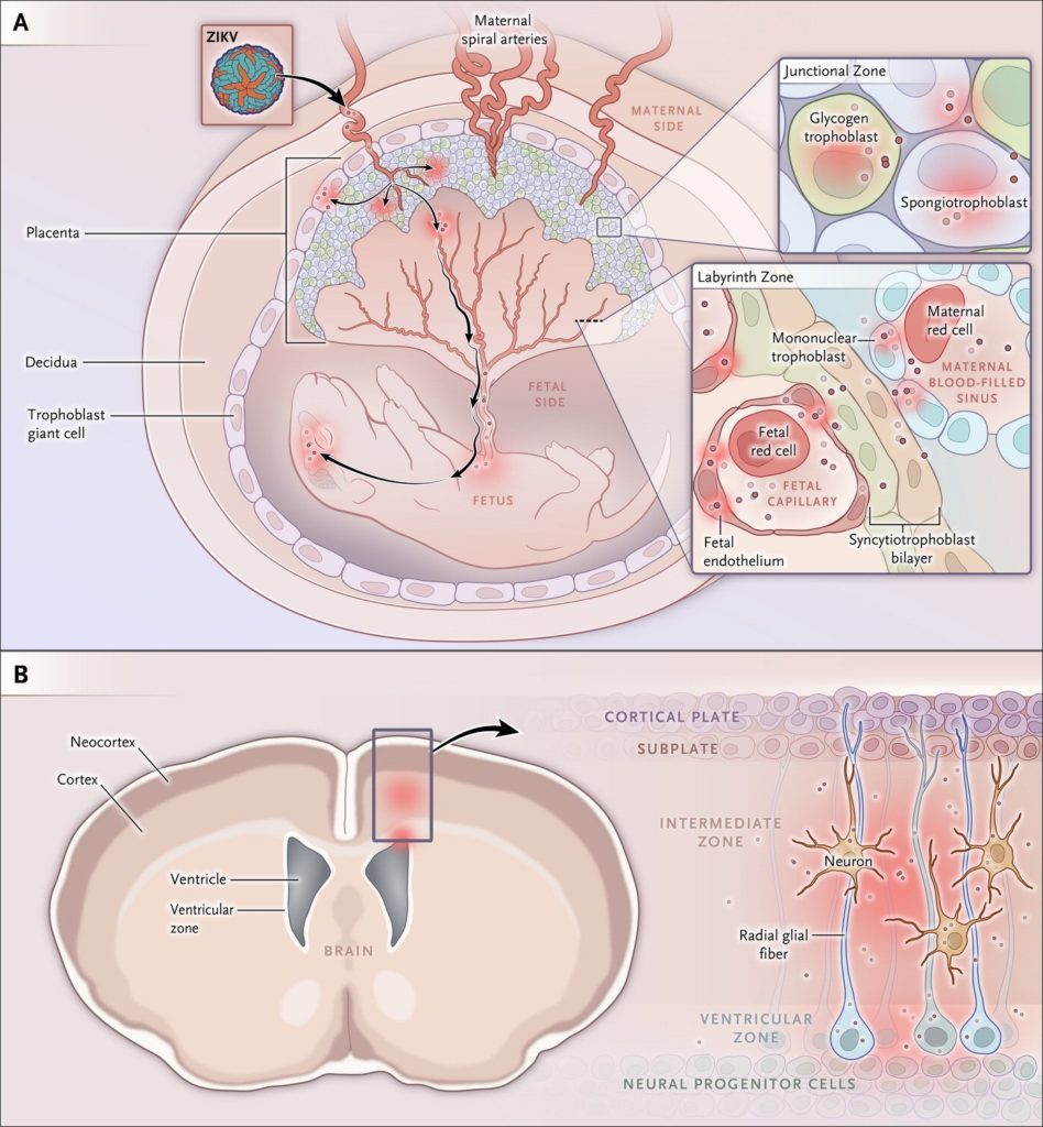 Figura 1. Siti cellulari d’infezione da Zika virus (ZIKV) in gravidanza. La placenta murina comprende componenti di derivazione materna e fetale, includendo le zone ‘giunzionale’ e del ‘labirinto’ (pannello A). Lo ZIKV può infettare trofoblasti placentari, comprese le cellule giganti trofoblastiche, il glicogeno trofoblastico, gli spongiotrofoblasti nella zona giunzionale, le cellule mononucleate trofoblastiche, i sinusoidi materni e le cellule endoteliali fetali che circondano i capillari fetali nella zona del labirinto (inserto). Lo ZIKV infetta il cervello fetale murino con tropismo per le cellule della corteccia cerebrale e della zona ventricolare, includendo le cellule progenitrici neurali corticali e le cellule gliali radiali (pannello B). 